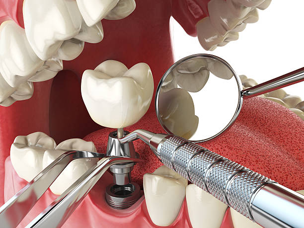 Best Emergency Treatment for Dental Infections or Abscesses in Donalsonville, GA